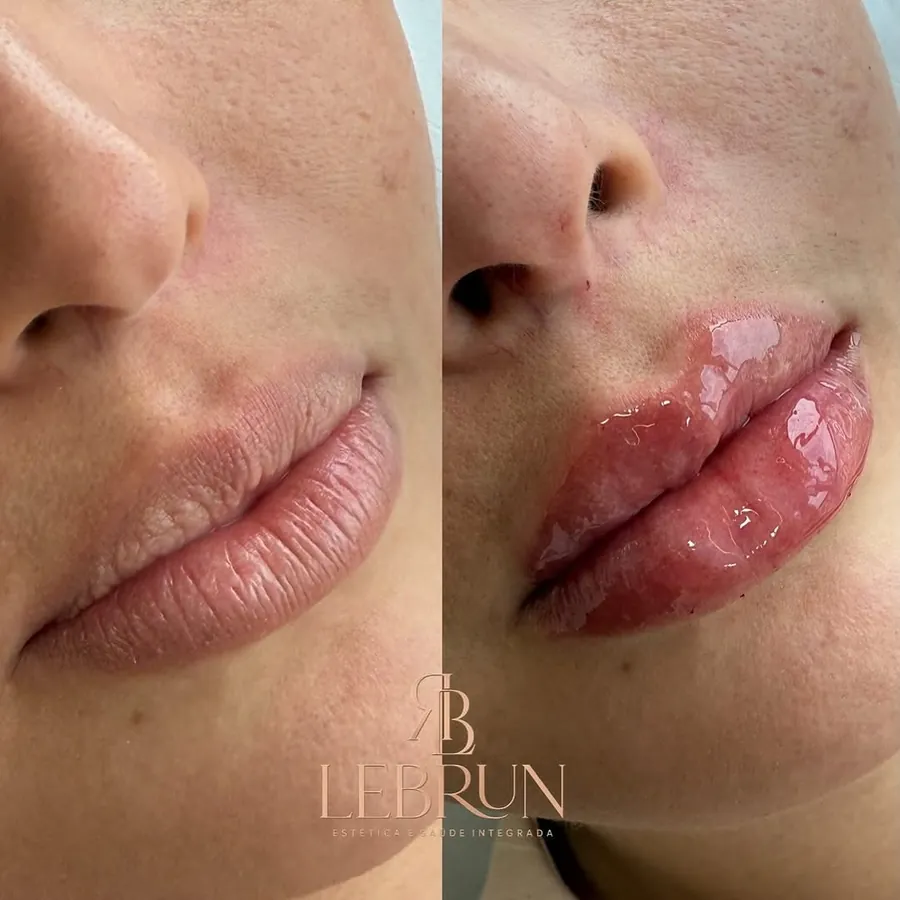 Lábios finos antes e depois do primeiro preenchimento