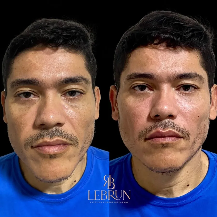 Rosto masculino antes e depois de tratamento facial