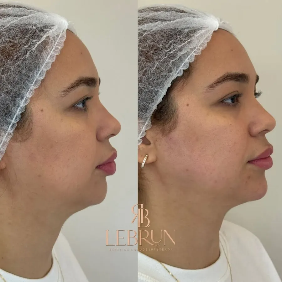 Perfil antes e depois do preenchimento de mento e mandíbula